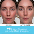 Before and after facial comparison showing reduced redness and smoother skin appearance on the right side.