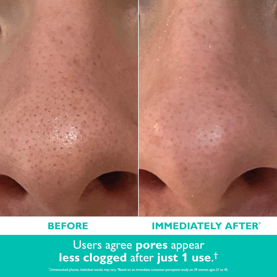 Before and after comparison of skin texture showing reduced pore appearance on facial area.