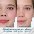 Before and after facial comparison showing reduced redness and cleaner skin on the right side.