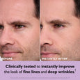 Before and after comparison of male face showing reduced appearance of forehead wrinkles and fine lines.