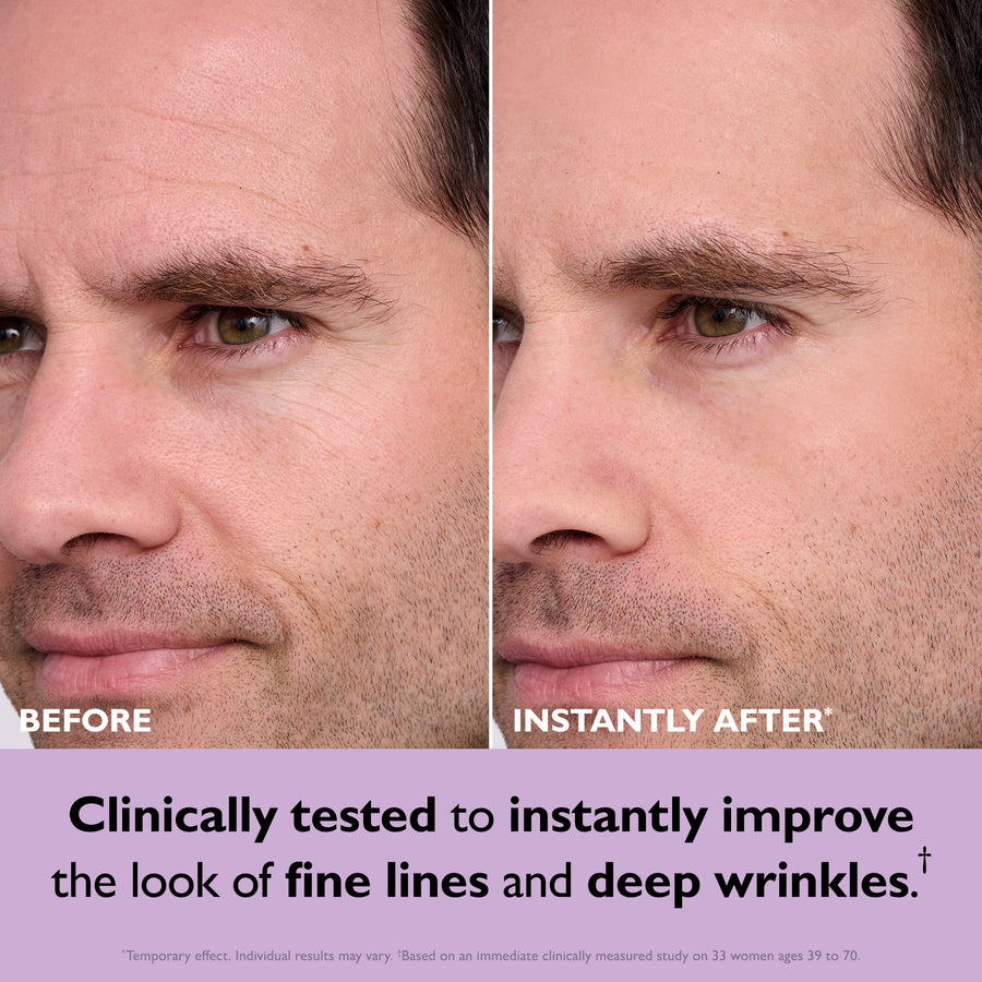 Before and after comparison of male face showing reduced appearance of forehead wrinkles and fine lines.