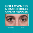 Before and after comparison showing eyes with reduced under-eye hollowness and dark circles.