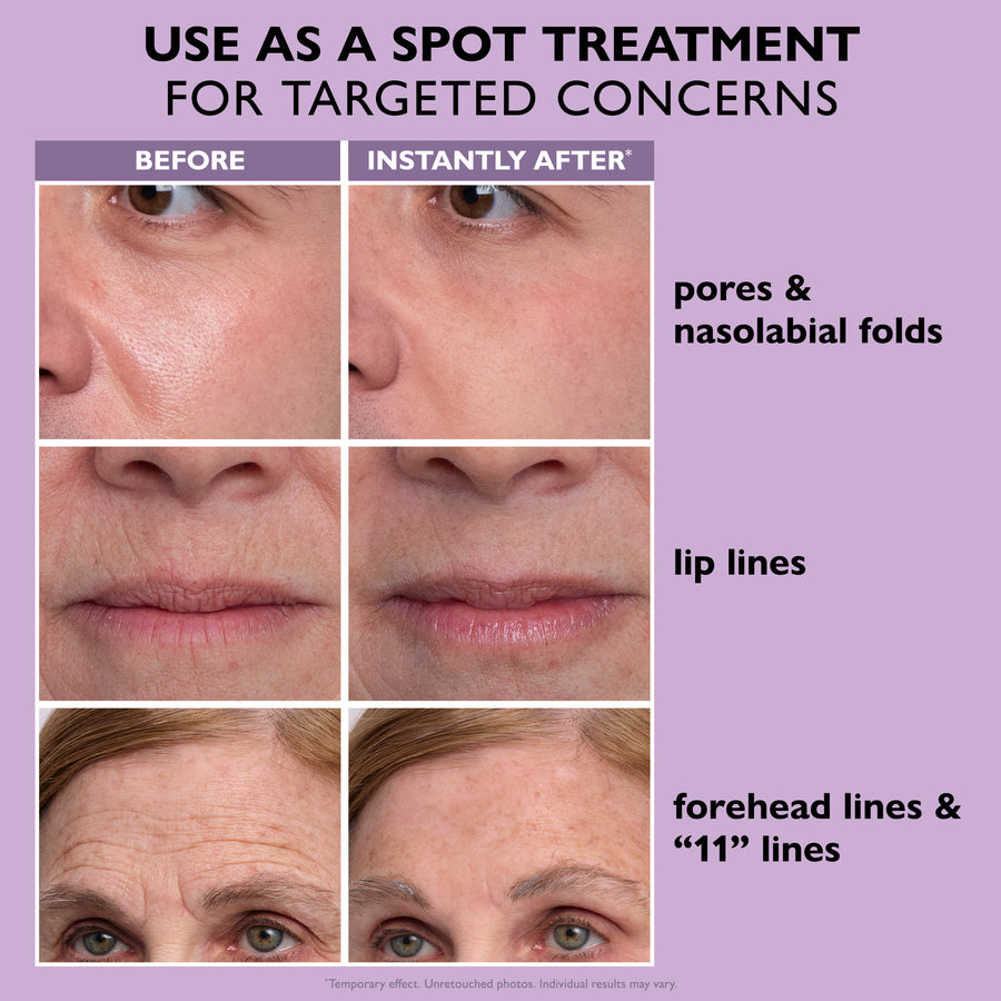 Before and after comparison showing facial skin with reduced pores, smoothed nasolabial folds, lip lines, and forehead wrinkl