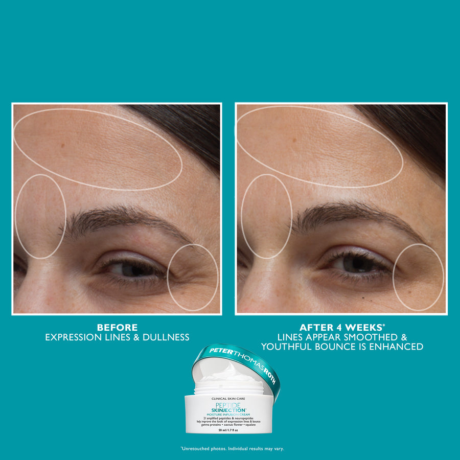 Two white jars of Peptide Skinjection cream displayed below before and after photos of facial skin showing forehead and eye a