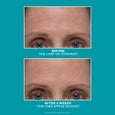 Before and after comparison of forehead showing fine lines and wrinkles on eyes and brow area.
