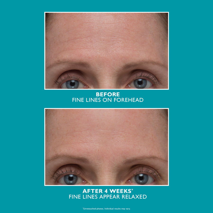 Before and after comparison of forehead showing fine lines and wrinkles on eyes and brow area.