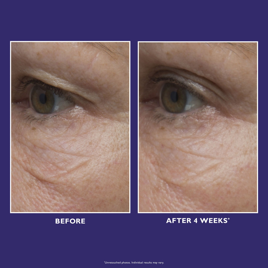 Before and after close-up of eye area showing skin texture around the eye with visible lines and wrinkles.