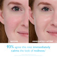 Before and after facial comparison showing reduced redness and improved skin appearance on woman's face.