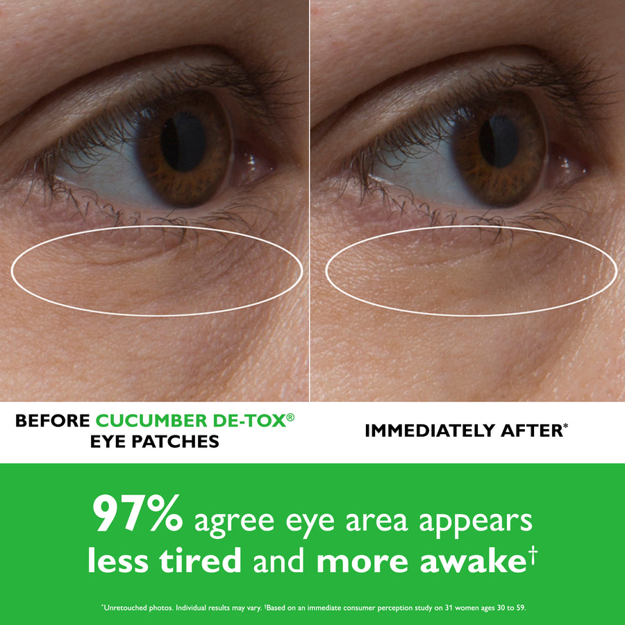 Before and after comparison showing under-eye area with white ovals highlighting reduced appearance of dark circles and puffi