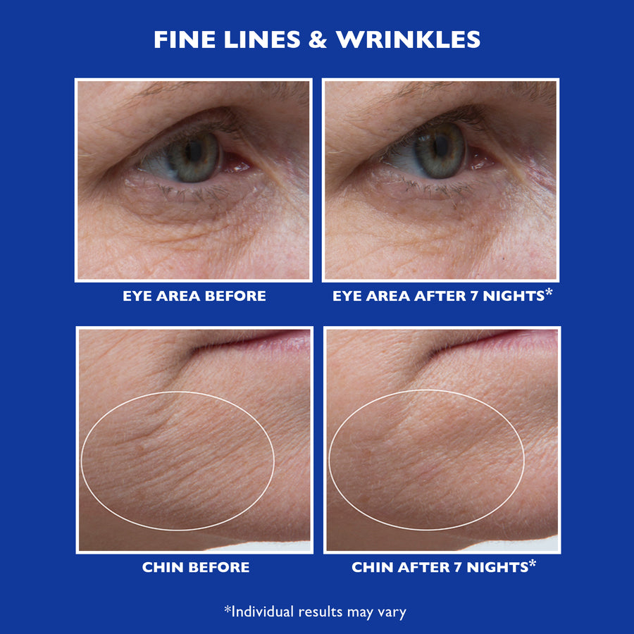 Before and after comparison of eye area and chin showing fine lines and wrinkles on blue background.