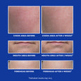 Before and after comparison showing cheek, mouth, and forehead skin texture on blue background.