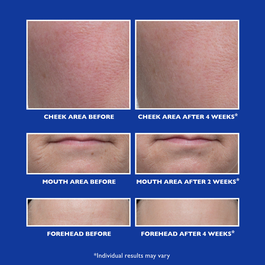 Before and after comparison showing cheek, mouth, and forehead skin texture on blue background.