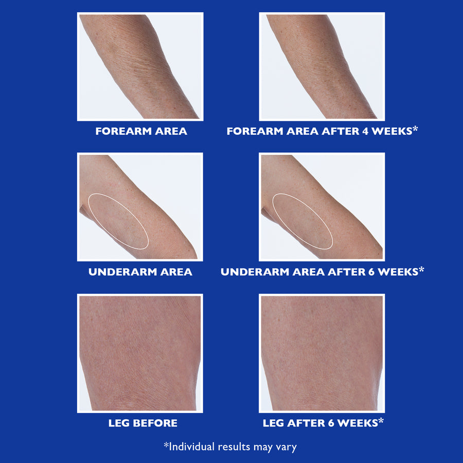 Six comparison photos of skin on forearm, underarm, and leg areas before and after product use on blue background.